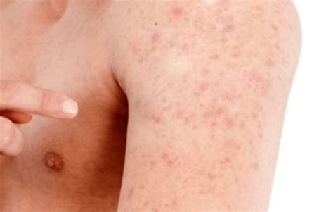 20 Common Causes Of Small Red Dots On Skin 2022