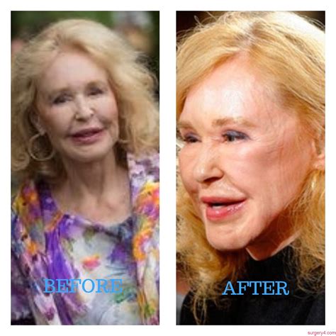 Are you looking at joan bennett are you interested to know joan bennett kennedy's body measurements? Joan Kennedy Plastic Surgery Photos Before & After ⋆ ...