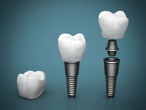 Titanium Dental Implants I Sydney Dental Aesthetics And Implants