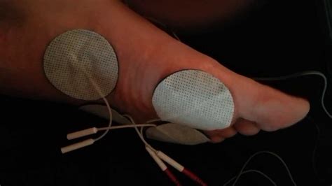 Neuromuscular Electrical Stimulation Nmes Youtube