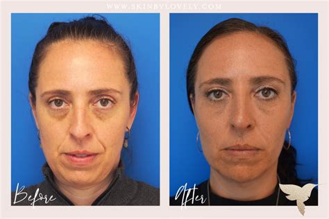Best Treatments For Nasolabial Folds And Marionette Lines Skin By Lovely