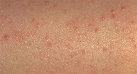 Dry Skin And Keratosis Pilaris Dermatologist In East Windsor Nj