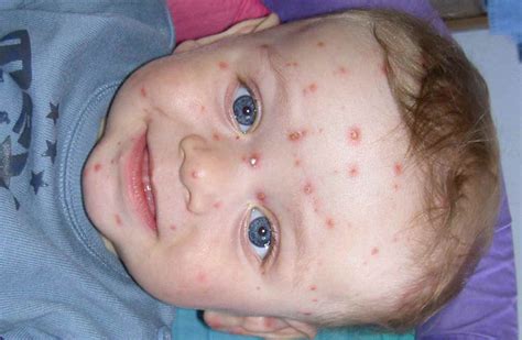 How To Clean Babys Face With Acne Whopping Great Webcast Image Archive