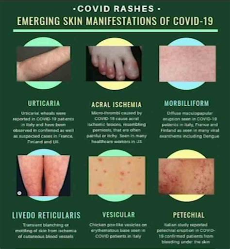 Dermatology Experts Say Skin Could Be Indicator Of Covid 19