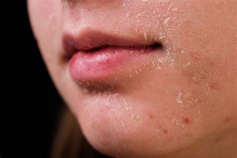 The Ultimate Guide To Treating Dry Skin On The Face Causes Symptoms
