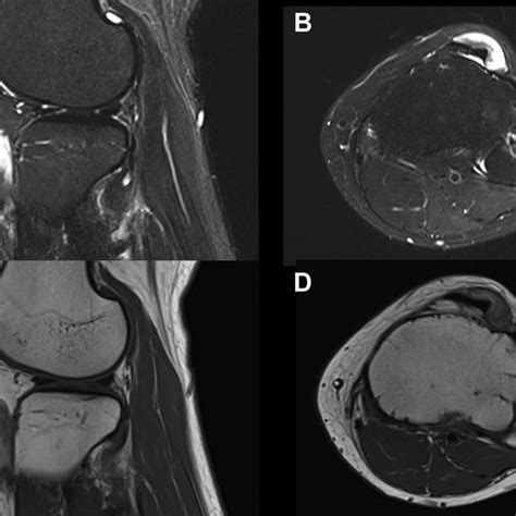 Pdf Endoscopic Resection Of Lipoma Of The Patellar Tendon