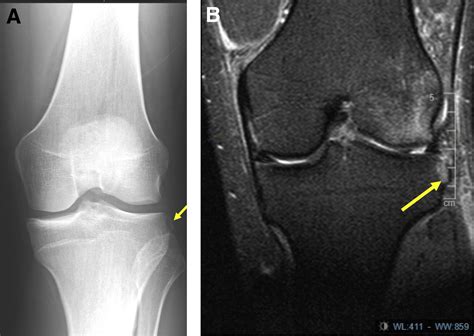 Segond Fractures Involve The Anterolateral Knee Capsule But Not The Iliotibial Band