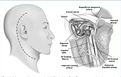 Figure 1 From Nonglomic Tumors Of The Jugular Foramen Differential