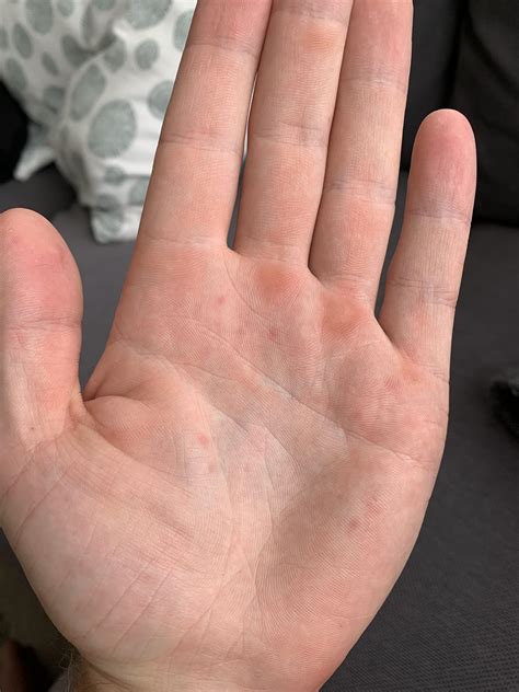 What Are These Small Bumps On The Palm Of My Hand I F