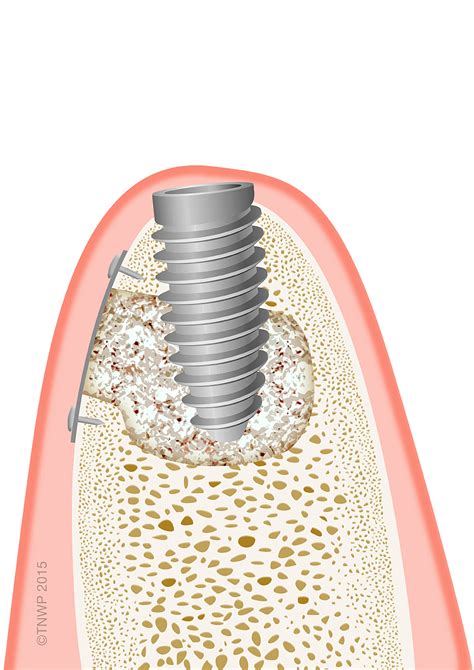Dental Implant Osseointegration Winchester Implant Dentist