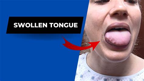 Swollen Tongue Helped By Dr Suh Specific Chiropractic Nyc Youtube