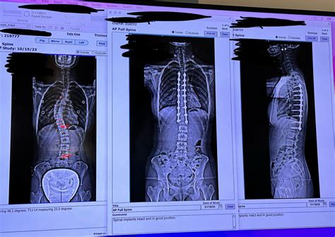 Before And After T4 L1 Spinal Fusion X Rays 4 Weeks Post Op R Scoliosis