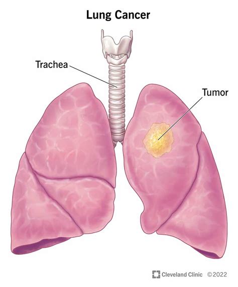 Understanding Lung Cancer Ask The Nurse Expert