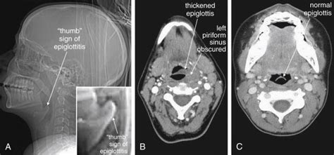 Imaging Soft Tissues Of The Neck Radiology Key