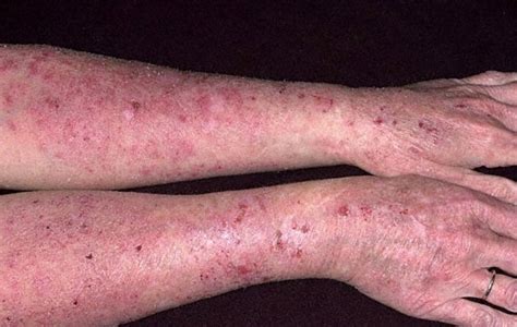 Eczema Pictures What Does Eczema Look Like
