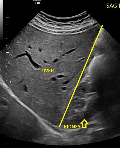 Fatty Liver And Ultrasound What You Need To Know The Ultrasound