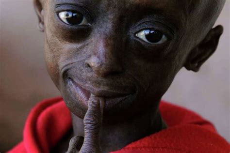 S Africa Has First Black Child With Progeria