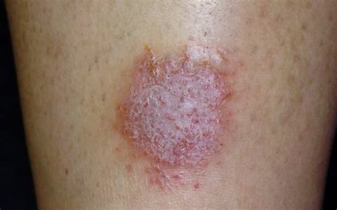 Discoid Eczema Pictures Pictures Photos