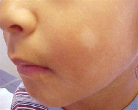 Malassezia fungi are specialized to live on skin and associated with dandruff, eczema. Pityriasis Alba - Pictures, Causes, Symptoms, Treatment ...