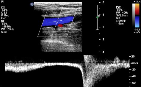 Dvt Ultrasound Protocol Step By Step Guide To Ruling Out A Dvt