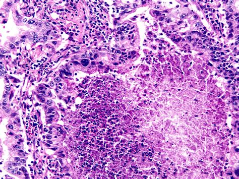 A Thread From Smlungpathguy 1 Necrosis Cell Death Unlike