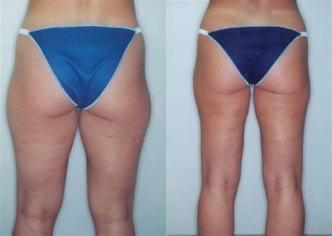 Thighs Liposuction Review Thigh Liposuction Laser Liposuction