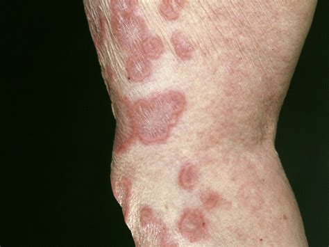 Mycosis Fungoides Tumor Stage Pictures Img Bade
