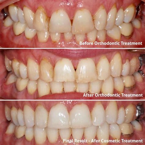 Damon Braces Before And After Helen Premier Orthodontics