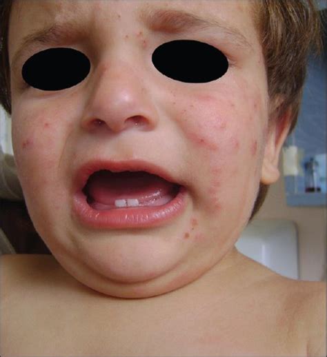 Papulovesicular Eruption Located On The Face And Extremities In A Child