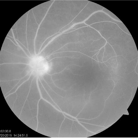 A Fundus Photograph Of The Left Eye Demonstrating Placoid Lesion
