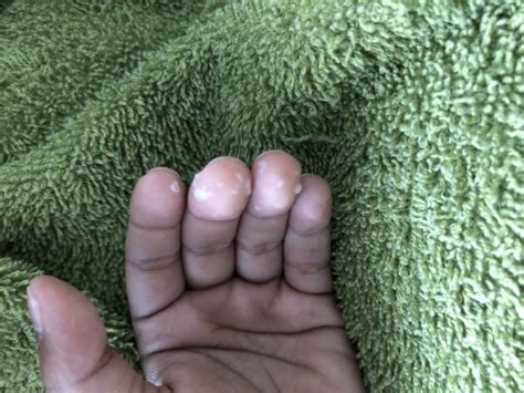 White Spots On My Sons Fingers Babycenter