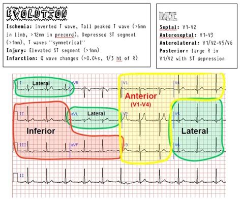 Printable Ekg Cheat Sheet Printable Coloring Pages