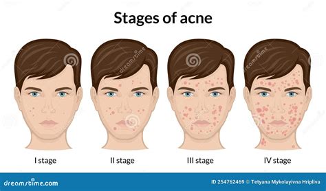 Stages Of Acne Stock Vector Illustration Of Acne Phase