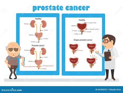 Stages Of Prostate Cancer From I To Iv The Tumor Grows And Penetrates Into Neighboring Organs