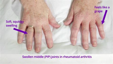 How To Self Examine For Tender And Swollen Joints In Ra