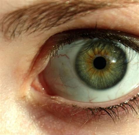 Why Do Some People Have Dark Rings Around The Iris Of Their Eye