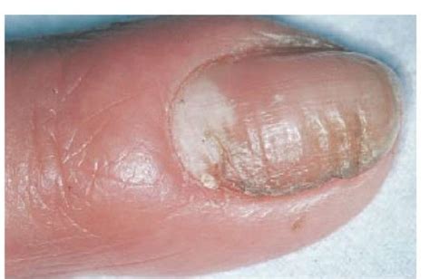 Fungal Bacterial And Viral Infections Of The Skin Part 2