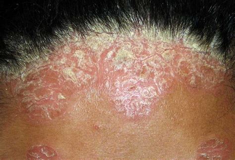 Scalp Psoriasis Pictures Symptoms And Treatment