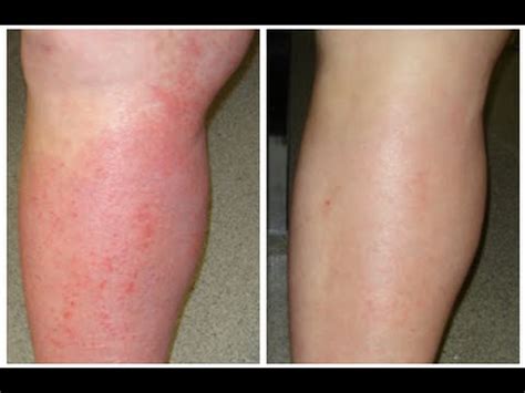 How to treat eczema naturally. 4 Natural Cures for Eczema : How to Cure Eczema Fast ...