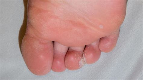 Mosaic Warts Symptoms Causes Treatments And More