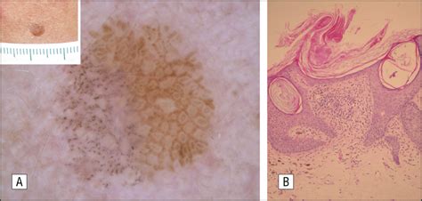 Dermoscopy Of Lichenoid Regressing Seborrheic Keratosis Dermatology