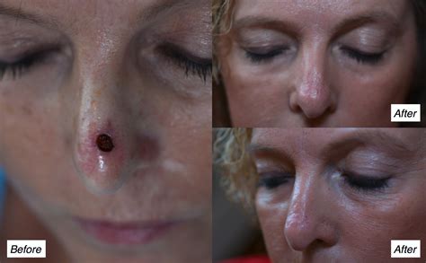 Nose Skin Cancer Copy Charleston Facial Plastic Surgery