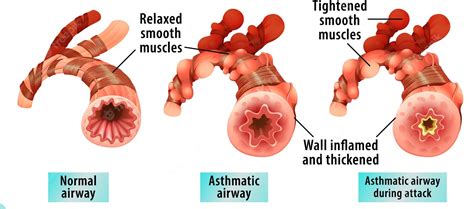 Bronchial Asthma Medtour