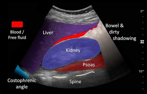 Had an ultrasound 5 days before my period is due & it said there was no free fluid in my pouch douglas but im unsure what that means? Ultrasound Case 069 • LITFL • POCUS Self-Assessment Quiz