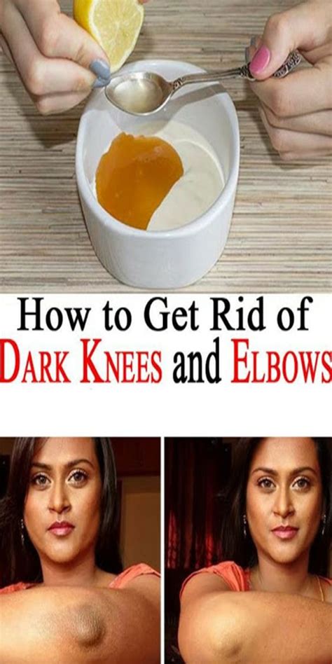 How To Get Rid Of Dark Elbows And Knees Naturally Beauty Care Health