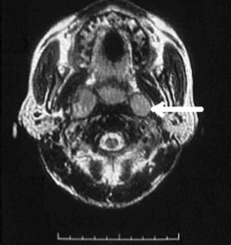 Retropharyngeal Lymph Node Metastasis In Nasopharyngeal Carcinoma