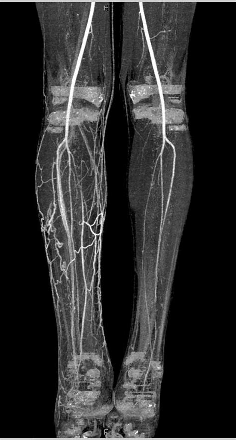 Ct Runoff With Venous Collaterals In Right Calf Vascular Case Studies