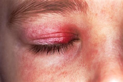 Eczema On Eyelids Causes And Cures