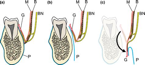 The Course And Distribution Of The Buccal Nerve Clinical Relevance In