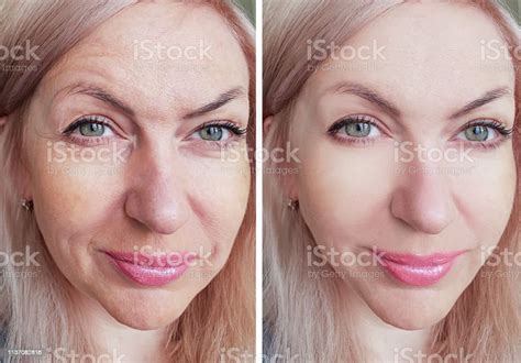Woman Wrinkles Before And After Procedures Stock Photo Download Image